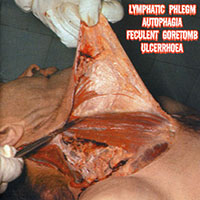 Lymphatic Phlegm